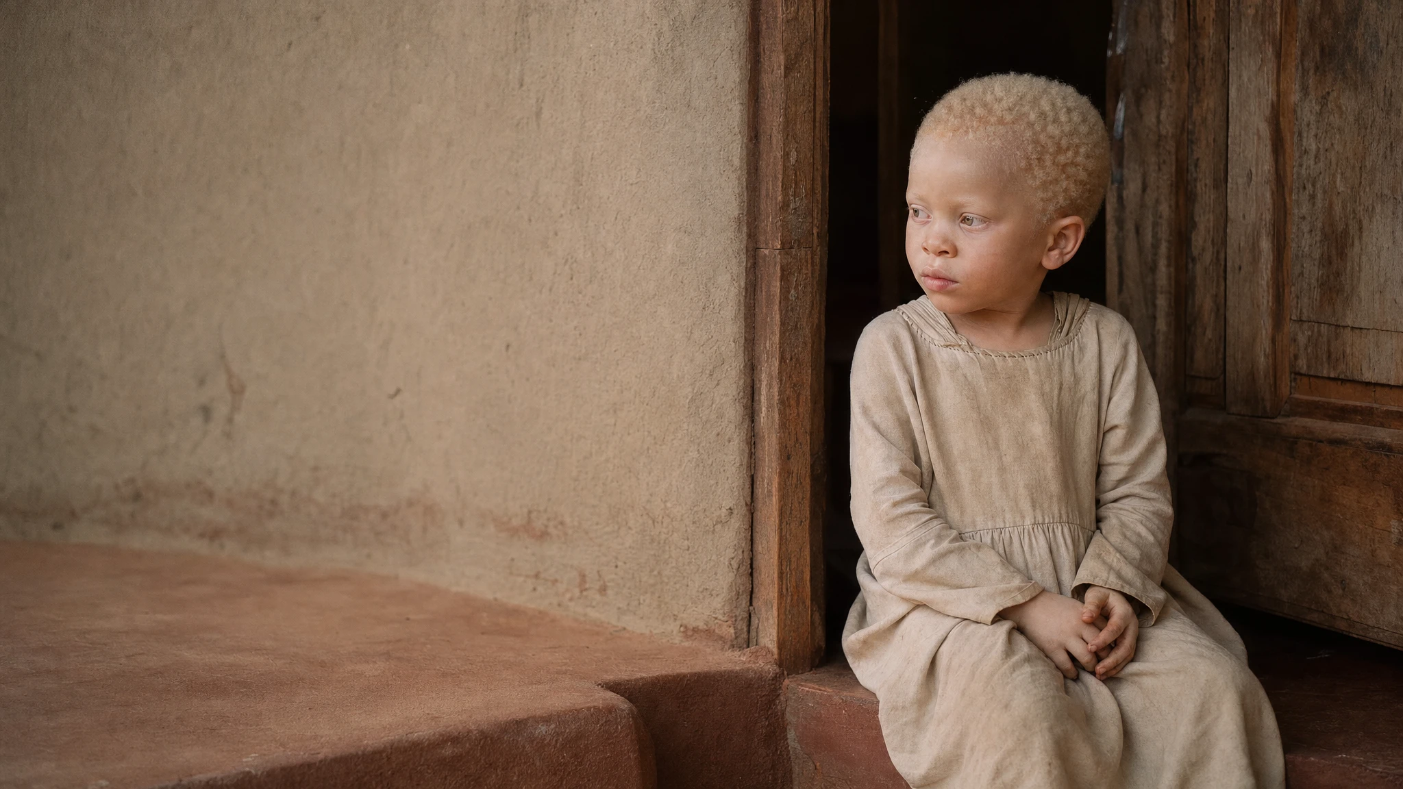 UN warns of surge in attacks on children with albinism