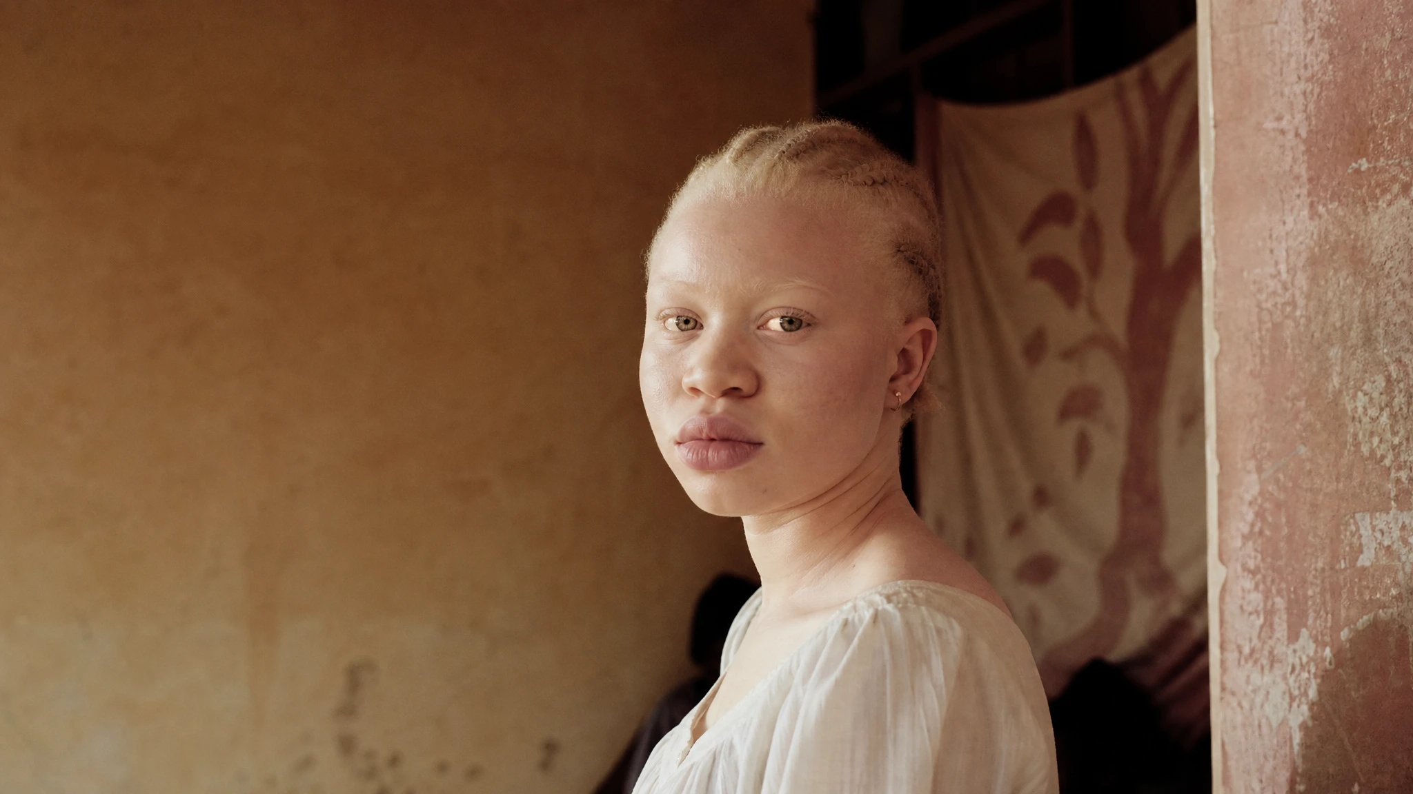International Albinism Day: beyond the medical lens