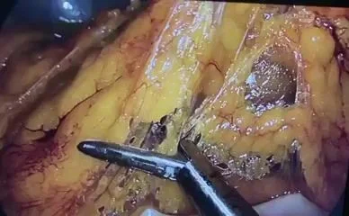 Лапароскопическая цефалическая дуоденопанкреатэктомия (Whipple)