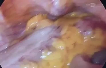 Left hemicolectomy при обструктивной опухоли нисходящей ободочной кишки