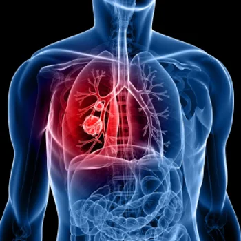 Data from the PALOMA-2 trial showed comparable efficacy with subcutaneous amivantamab vs prior reports of the intravenous formulation.