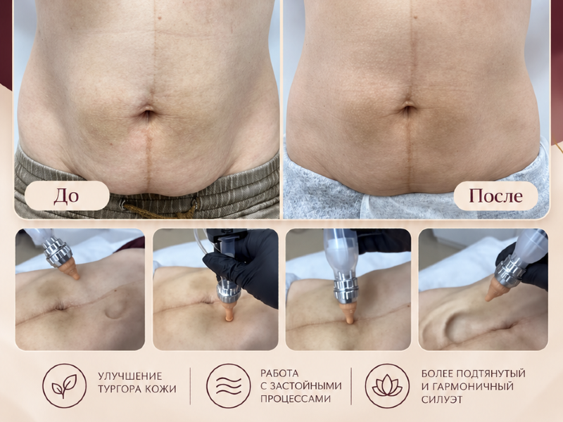 На фото: клиентка до и после курса из 10 уходов SKINHALE раз в неделю. Результат индивидуален.