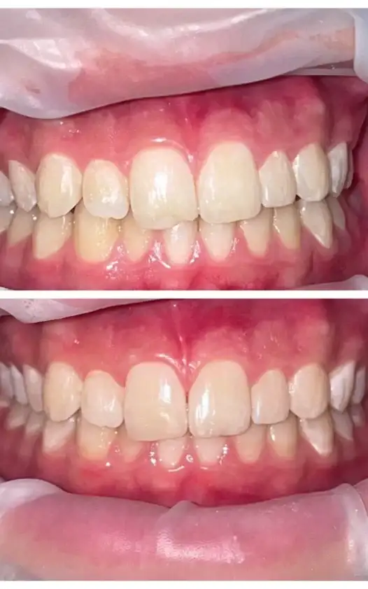 Композитные пломбы