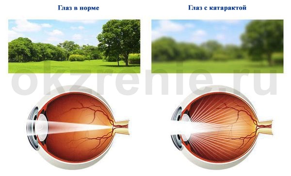 nachalnaya-katarakta-1.jpg