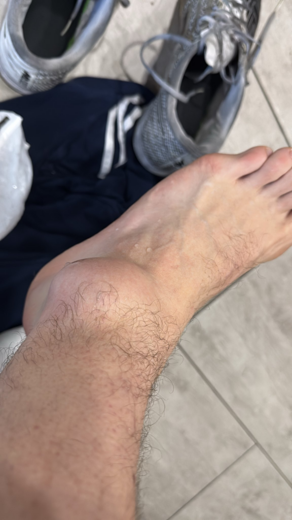 «Кость чуть-чуть треснула, а связки сильно растянуты» - HuNter о травме, из-за которой пропустит IEM Rio