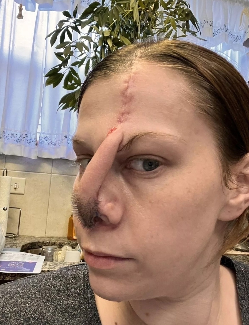 У 38-летней девушки разрушился нос после трех месяцев злоупотребления запрещенны…