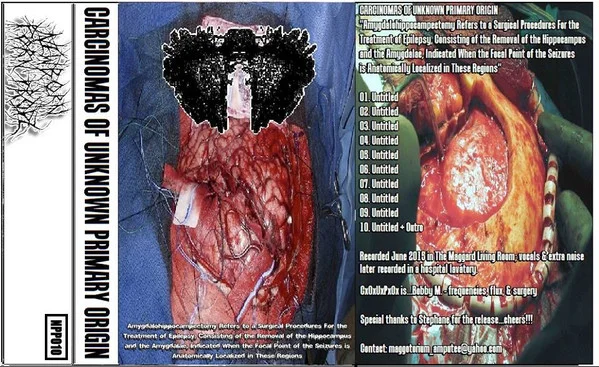 Amygdalohippocampectomy Refers To A Surgical Procedures For The Treatment Of Epilepsy, Consisting Of The Removal Of The Hippocampus And The Amygdalae, Indicated When The Focal Point Of The Seizures Is Anatomically Localized In These Regions