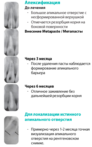 Метапаста