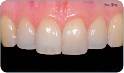 Световой композит GC G-aenial Anterior