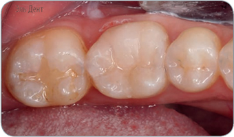 Световой композит GC G-aenial Posterior