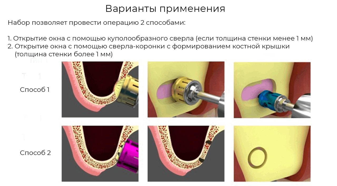 Laskit_variation