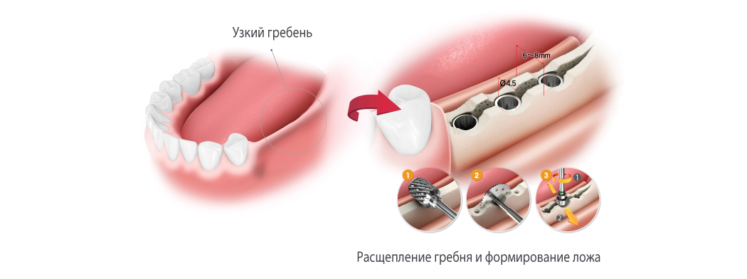 Esset kit