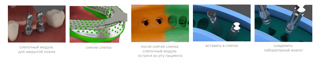 Convertible - слепочный модуль-5
