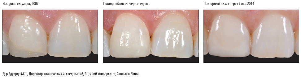 Композит Импресс Дайрект Рефилл