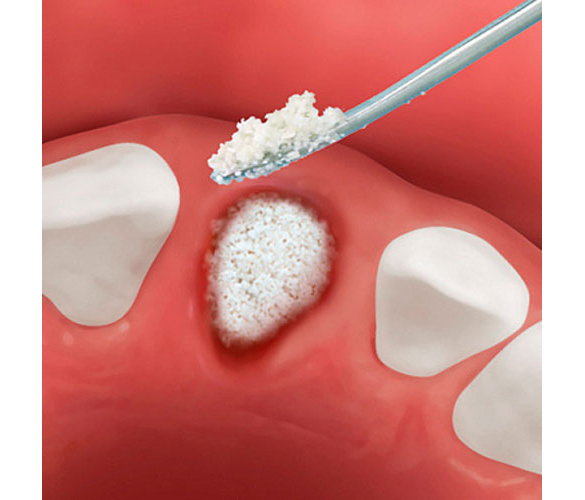 OsteoBiol Osteobiol Apatos Mix - гранулы из смеси губчатой и кортикальной кости без коллагена