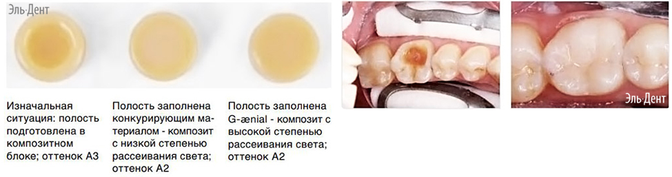 Световой композит GC G-aenial Anterior