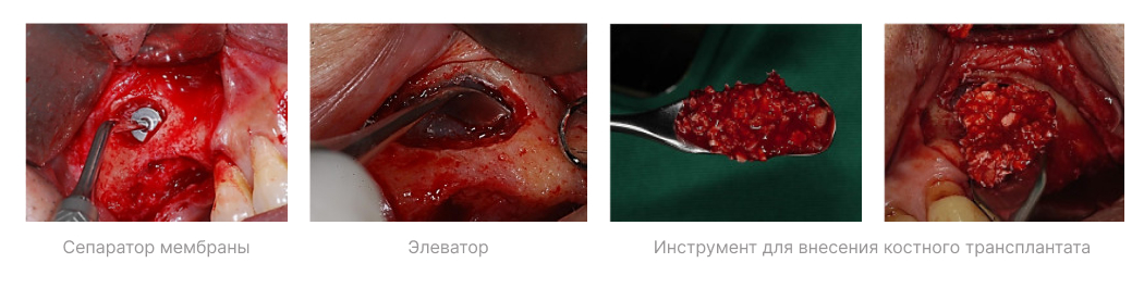 Sinus kit