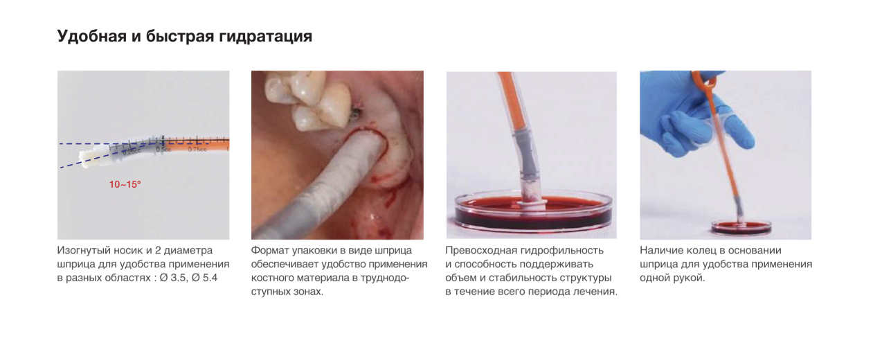 применение костного ксенотрансплантата OSSTEM A-Oss Pen