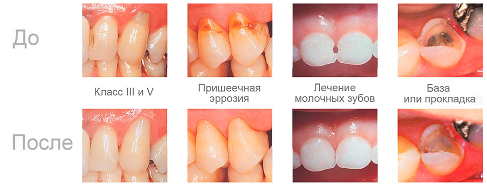 Фуджи 2 Цементы пломбировочные (реставрационные) GC Fuji II LC
