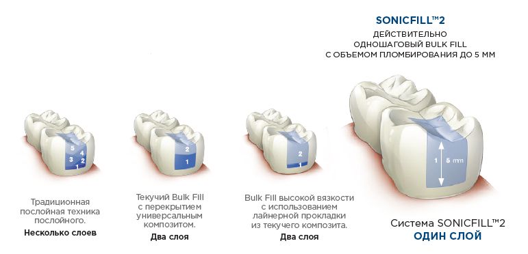 SonicFill Соникфилл-Наконечник стоматологический kerr