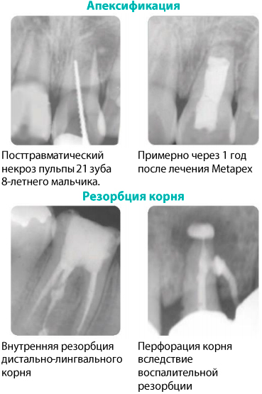Метапекс