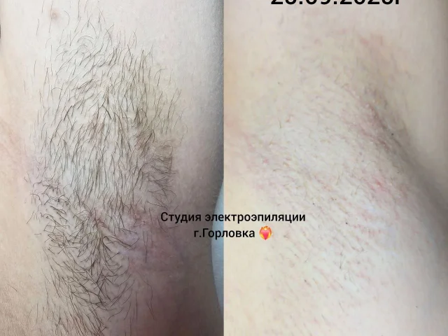Фото: Добро пожаловать в нашу студию ЭЛЕКТРОЭПИЛЯЦИИ! 💝🥰