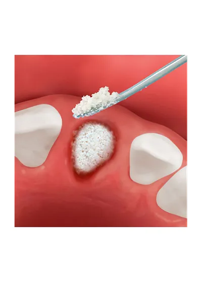 OsteoBiol Osteobiol Apatos Mix - гранулы из смеси губчатой и кортикальной кости без коллагена