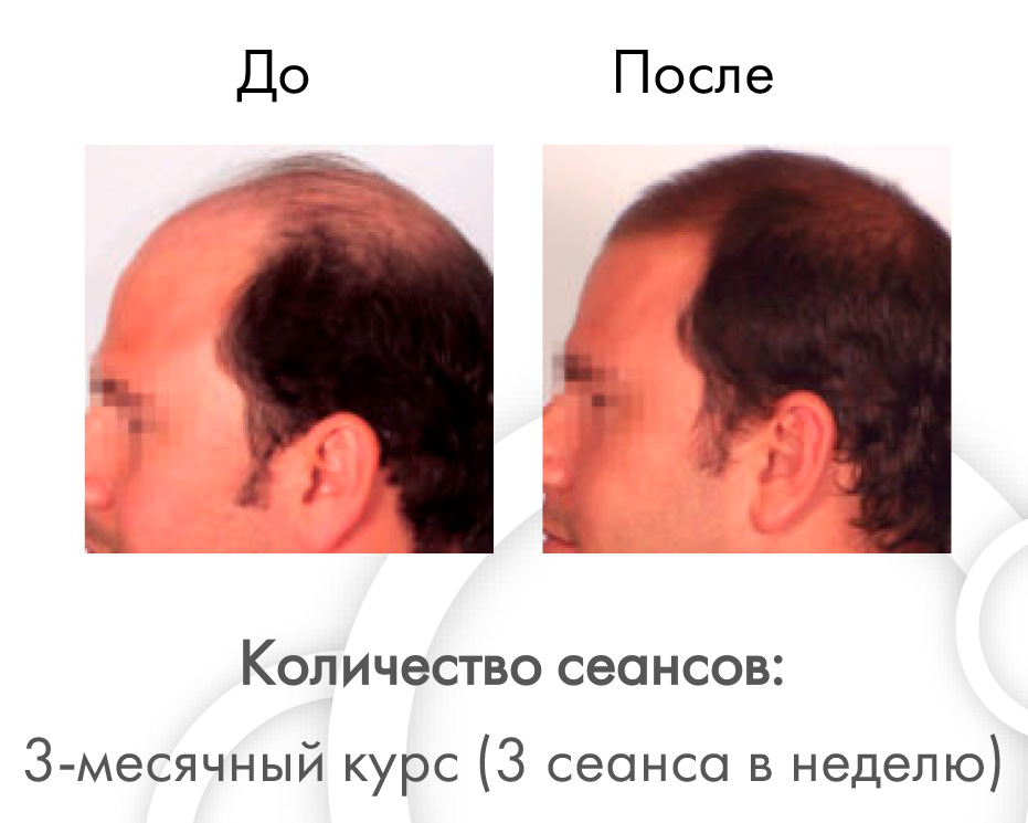 Активная клеточная терапия Индиба (INDIBA-Beauty)