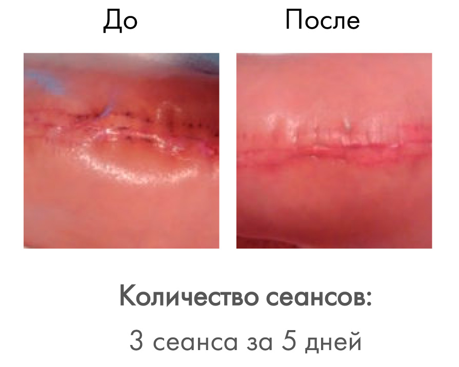 Активная клеточная терапия Индиба (INDIBA-Beauty)
