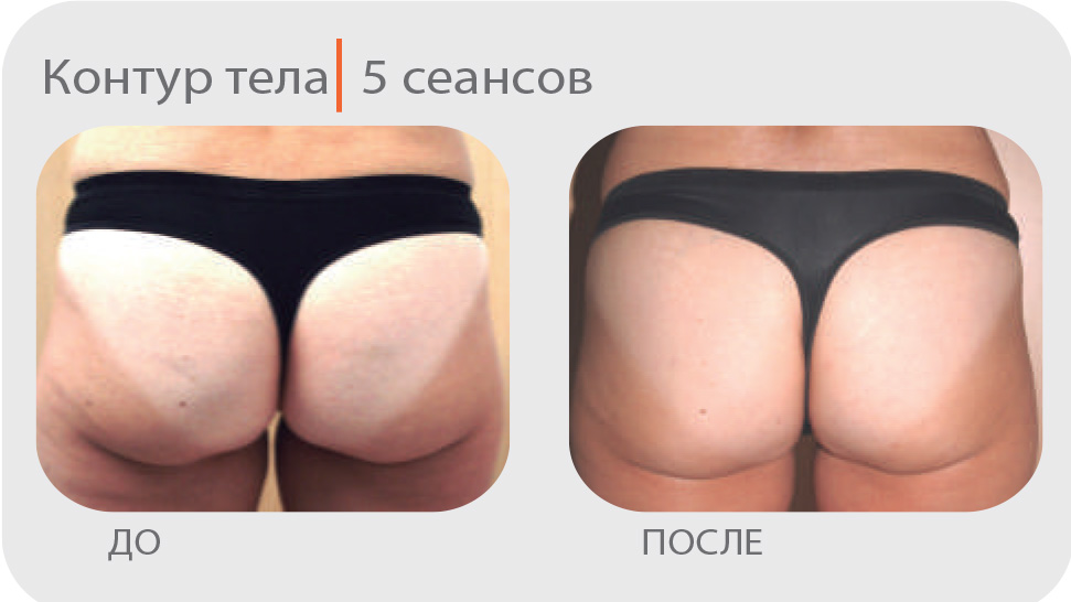 Активная клеточная терапия Индиба (INDIBA-Beauty)