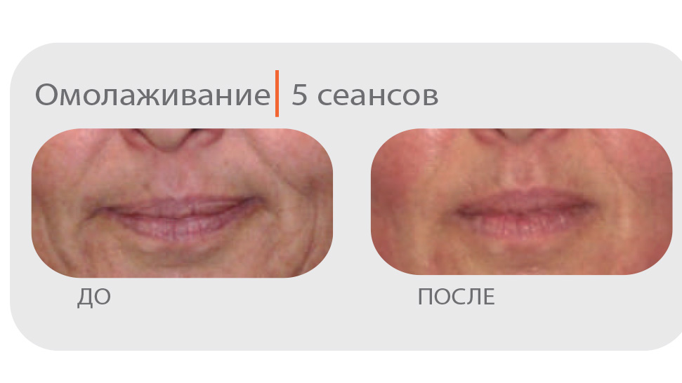 Активная клеточная терапия Индиба (INDIBA-Beauty)