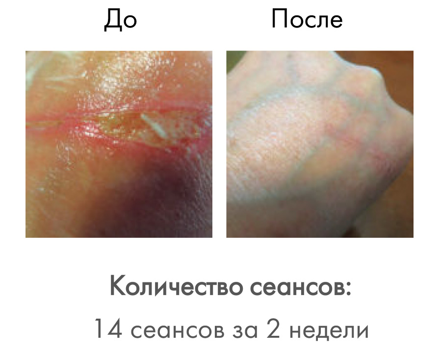 Активная клеточная терапия Индиба (INDIBA-Beauty)