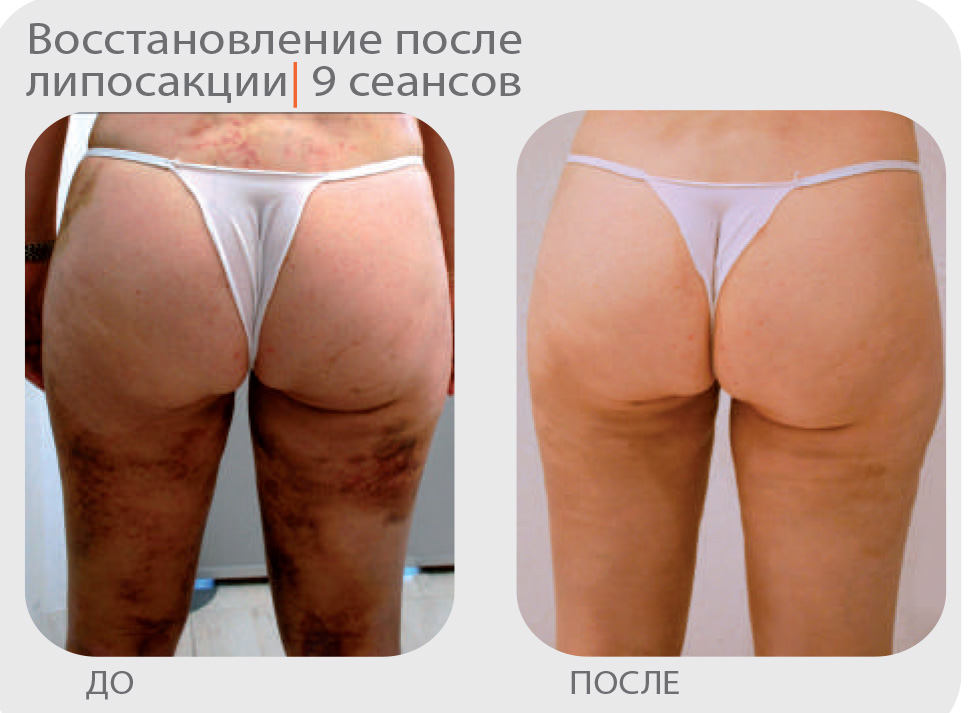 Активная клеточная терапия Индиба (INDIBA-Beauty)